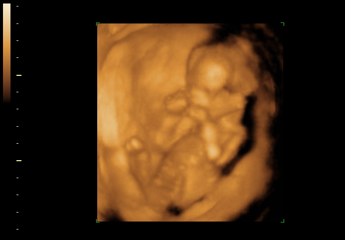 3D ultrasound image at 16 weeks